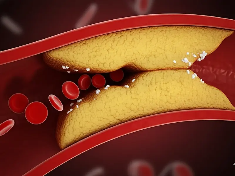 Médico vascular explica o que realmente ajuda a reduzir a gordura nas artérias e proteger o coração