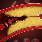 Médico vascular explica o que realmente ajuda a reduzir a gordura nas artérias e proteger o coração